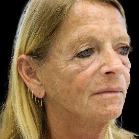 B&A - Before