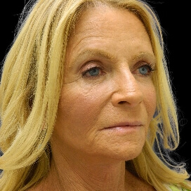B&A - After