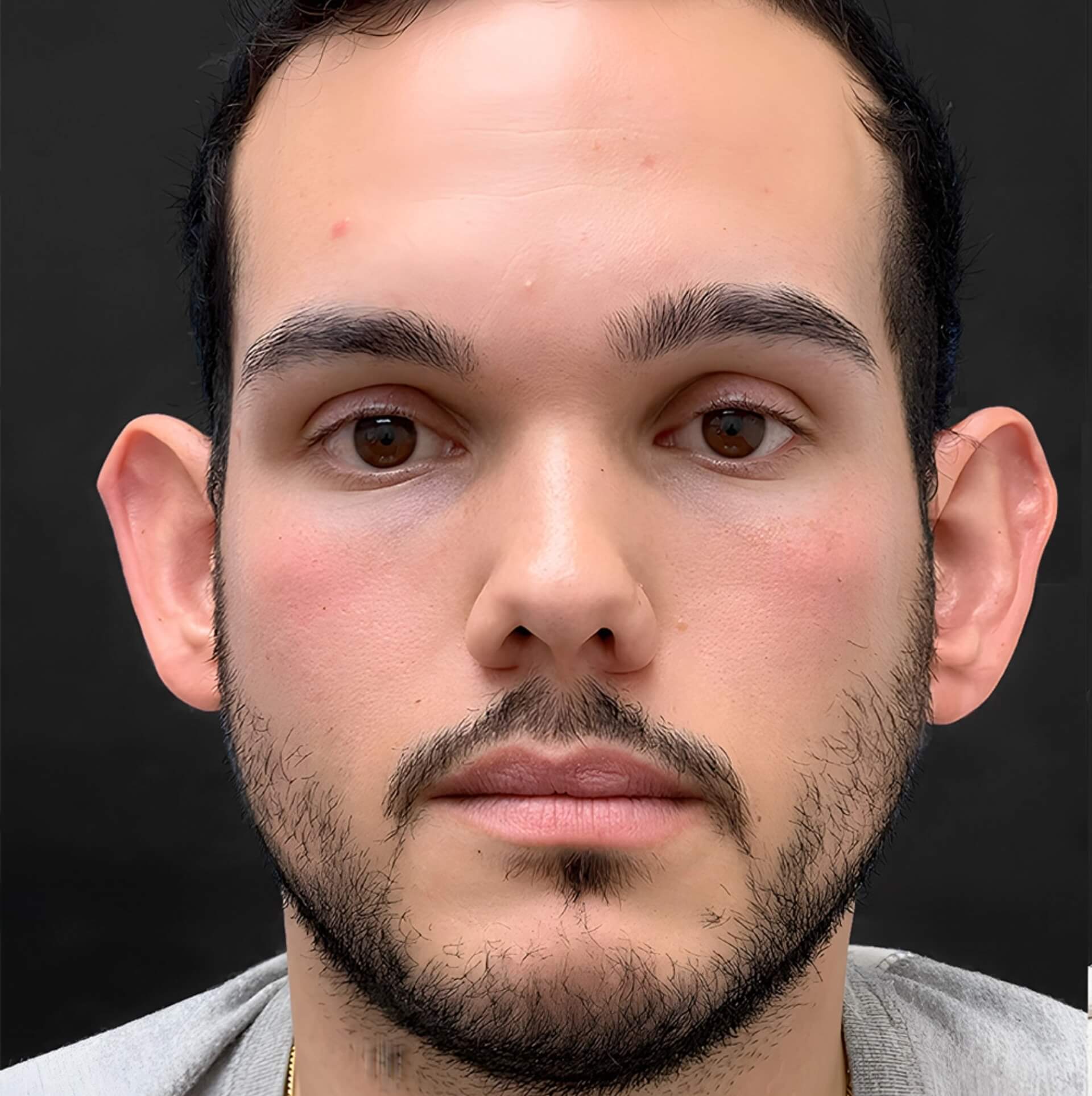 B&A - Before