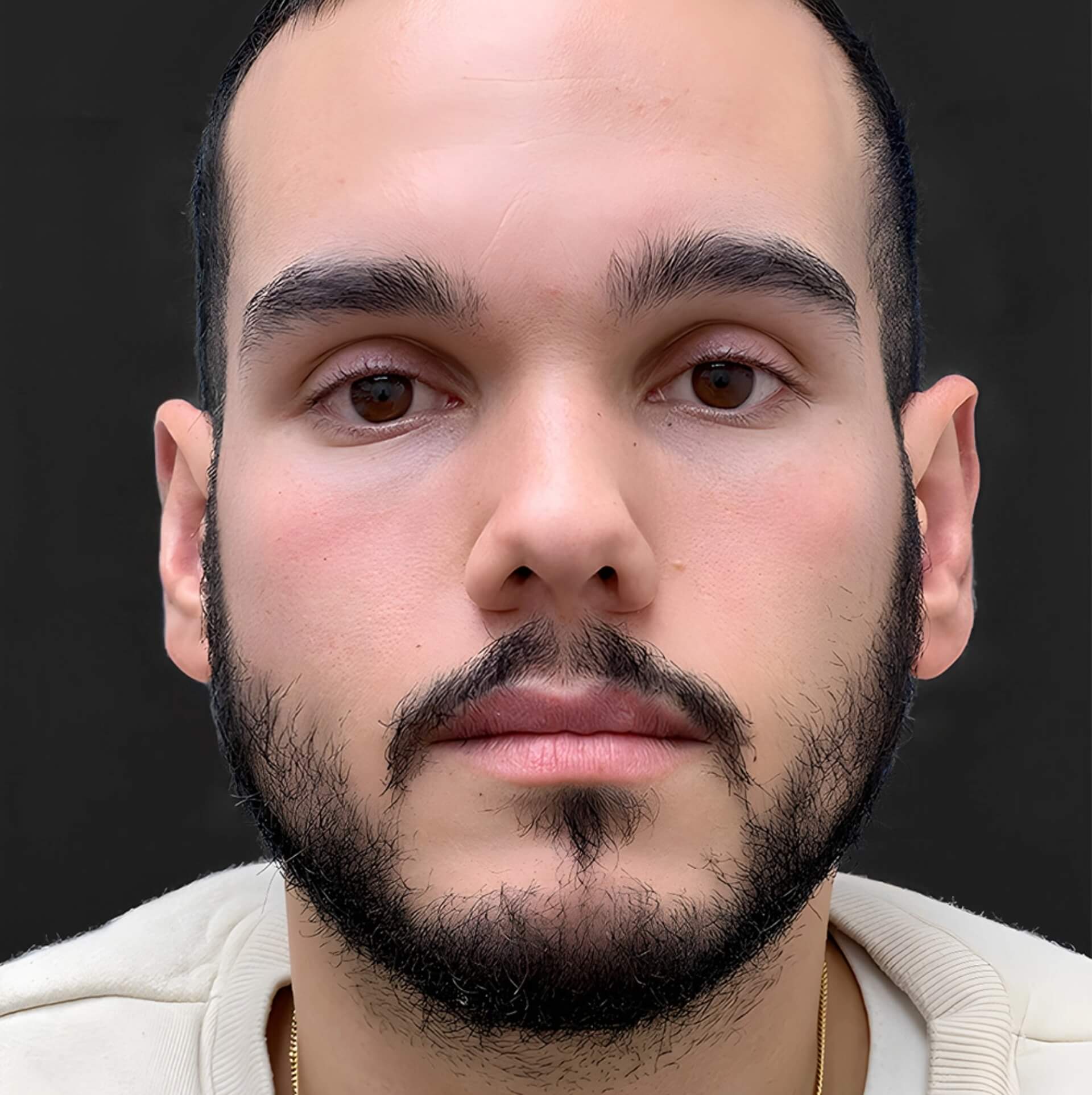B&A - After