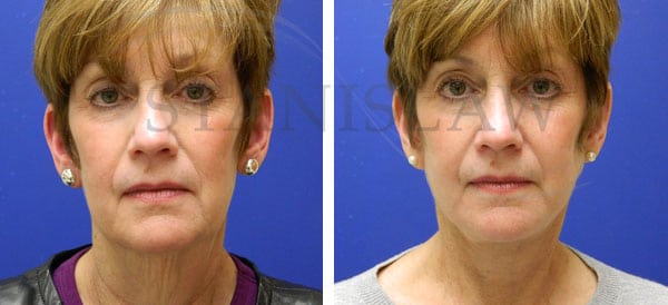 What is the cost of a facelift or neck lift?