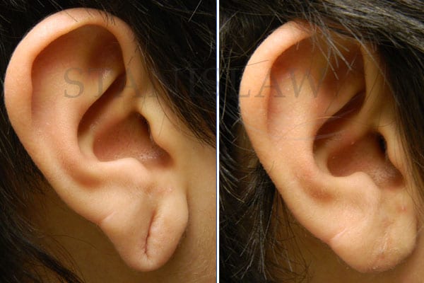 🥇 Treating Stretched or Torn Earlobes