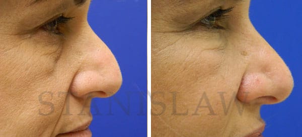 liquid rhinoplasty las vegas