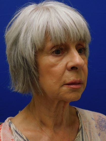 Face/Neck Lift Before & After Patient #524