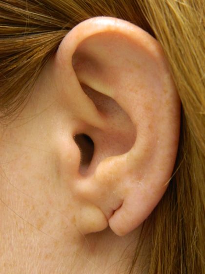 Earlobe Repair Before & After Patient #398