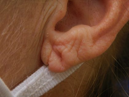 Earlobe Repair Before & After Patient #364