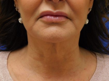 Face/Neck Lift Before & After Patient #492