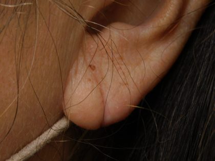 Earlobe Repair Before & After Patient #373