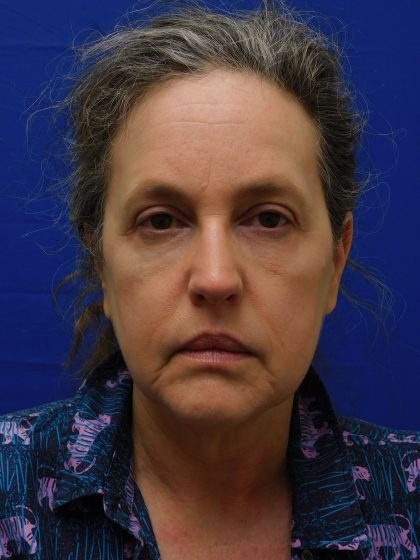 Face/Neck Lift Before & After Patient #513