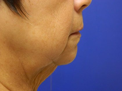 Face/Neck Lift Before & After Patient #558