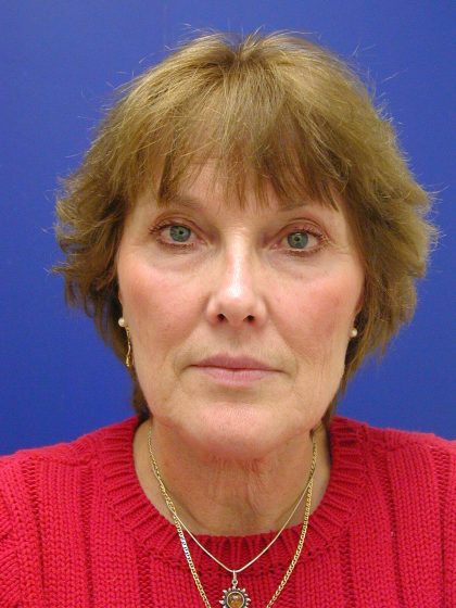 Face/Neck Lift Before & After Patient #549