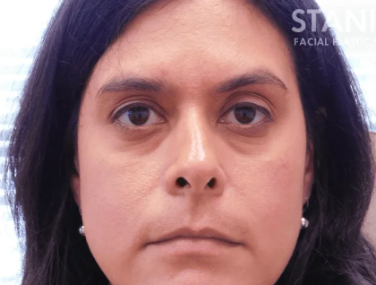 Botox Dysport Before & After Patient #151