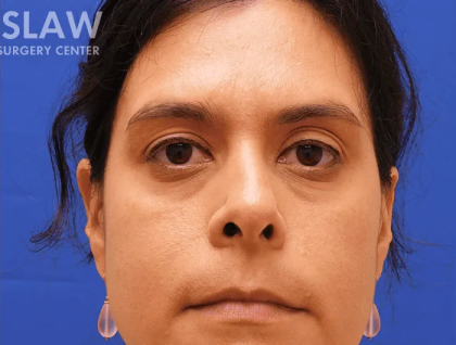 Botox Dysport Before & After Patient #151