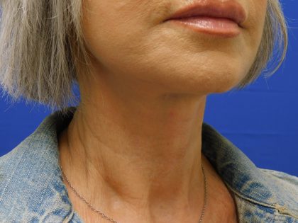 Face/Neck Lift Before & After Patient #524