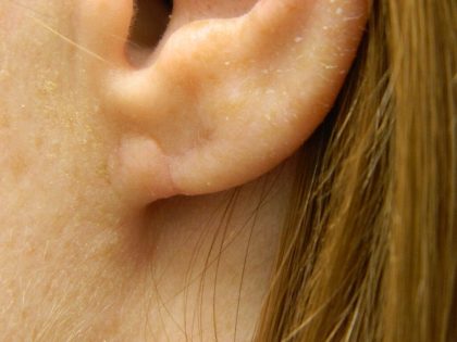 Earlobe Repair Before & After Patient #398