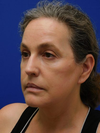 Face/Neck Lift Before & After Patient #513