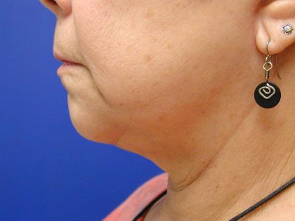 Face/Neck Lift Before & After Patient #558