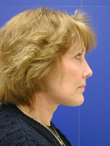 Face/Neck Lift Before & After Patient #549