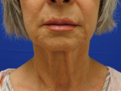 Face/Neck Lift Before & After Patient #524