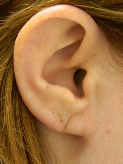Earlobe Repair Before & After Patient #398