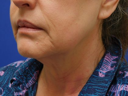 Face/Neck Lift Before & After Patient #513