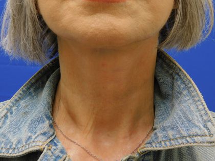 Face/Neck Lift Before & After Patient #524