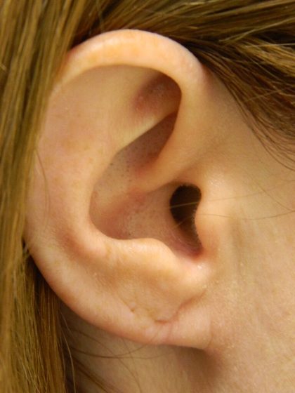 Earlobe Repair Before & After Patient #398