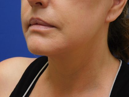 Face/Neck Lift Before & After Patient #513