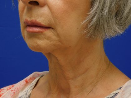 Face/Neck Lift Before & After Patient #524