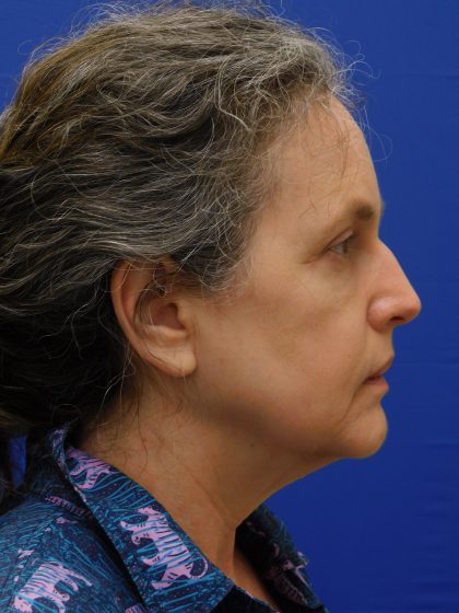 Face/Neck Lift Before & After Patient #513