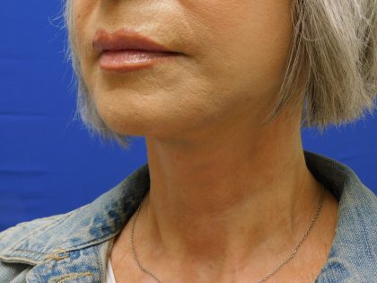 Face/Neck Lift Before & After Patient #524