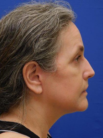 Face/Neck Lift Before & After Patient #513