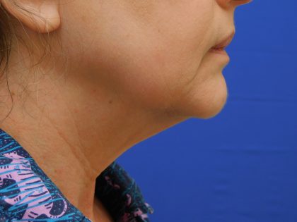 Face/Neck Lift Before & After Patient #513