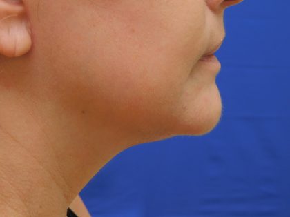 Face/Neck Lift Before & After Patient #513