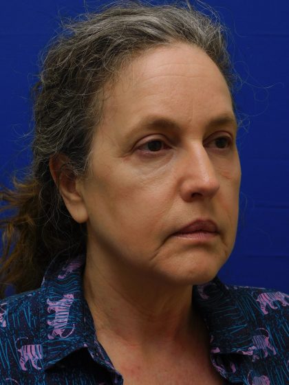 Face/Neck Lift Before & After Patient #513