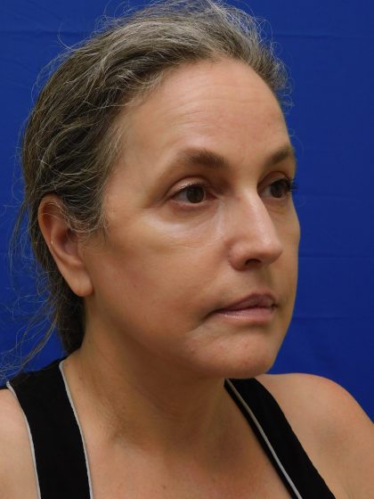 Face/Neck Lift Before & After Patient #513
