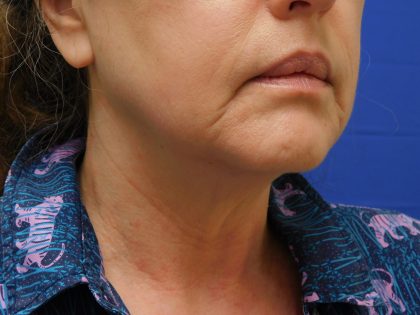 Face/Neck Lift Before & After Patient #513