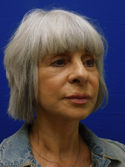 Face/Neck Lift Before & After Patient #524