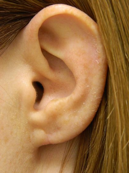 Earlobe Repair Before & After Patient #398