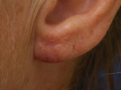 Earlobe Repair Before & After Patient #364