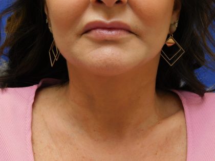 Face/Neck Lift Before & After Patient #492