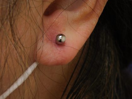 Earlobe Repair Before & After Patient #373