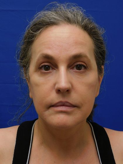 Face/Neck Lift Before & After Patient #513
