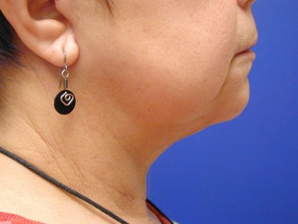 Face/Neck Lift Before & After Patient #558