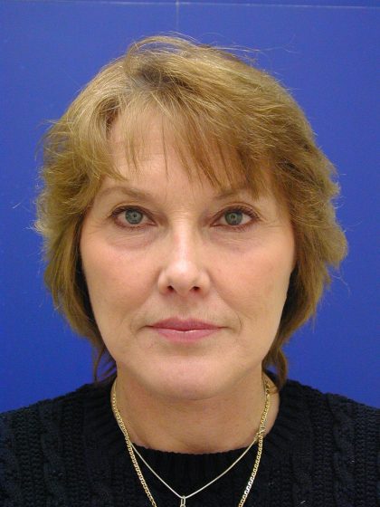 Face/Neck Lift Before & After Patient #549