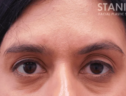 Botox Dysport Before & After Patient #151
