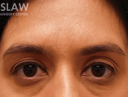 Botox Dysport Before & After Patient #151