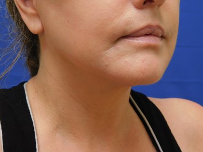 Face/Neck Lift Before & After Patient #513
