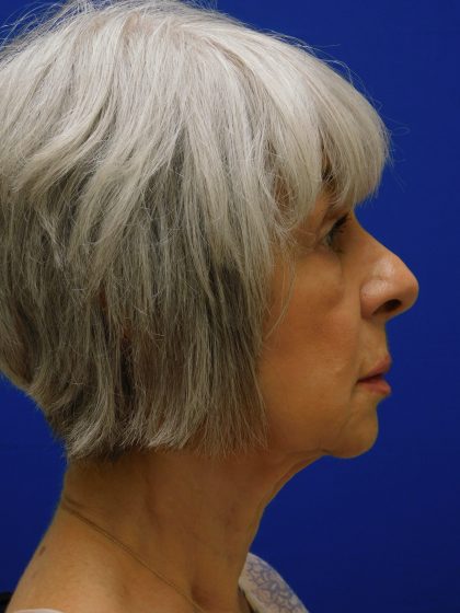 Face/Neck Lift Before & After Patient #524