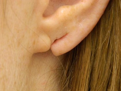 Earlobe Repair Before & After Patient #398